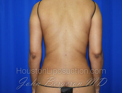 Liposuction Before & After Patient #2463
