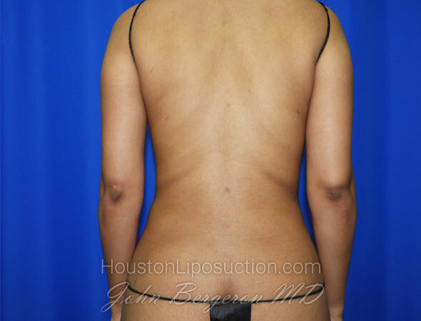 Liposuction Before & After Patient #2463