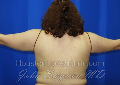 Liposuction Before & After Patient #2516