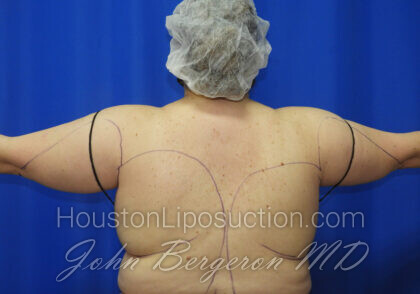 Liposuction Before & After Patient #2516