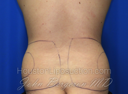 Liposuction Before & After Patient #2541