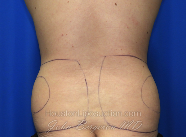 Liposuction Before & After Patient #2541