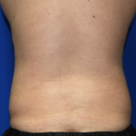 Liposuction Before & After Patient #2541