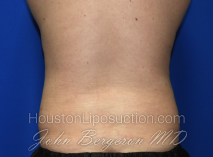 Liposuction Before & After Patient #2541