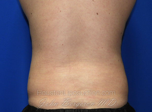 Liposuction Before & After Patient #2541