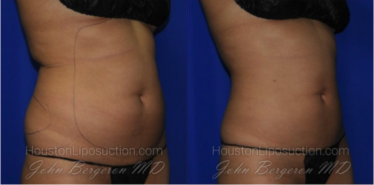 Waist & Hip Liposuction / Houston Lipo Center