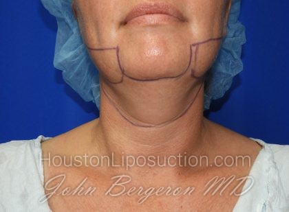 Liposuction Before & After Patient #2558