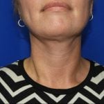 Liposuction Before & After Patient #2558