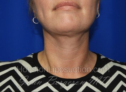 Liposuction Before & After Patient #2558