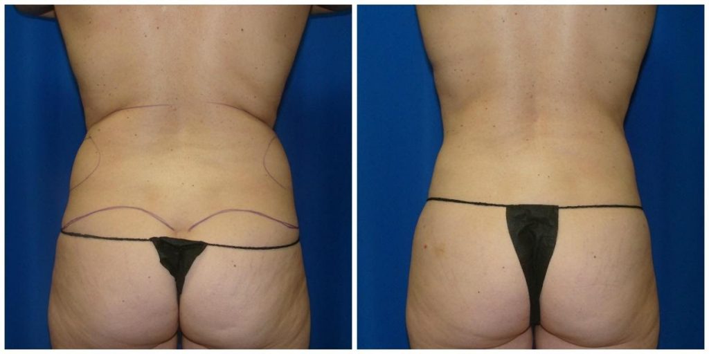 Liposuction Before and After Results