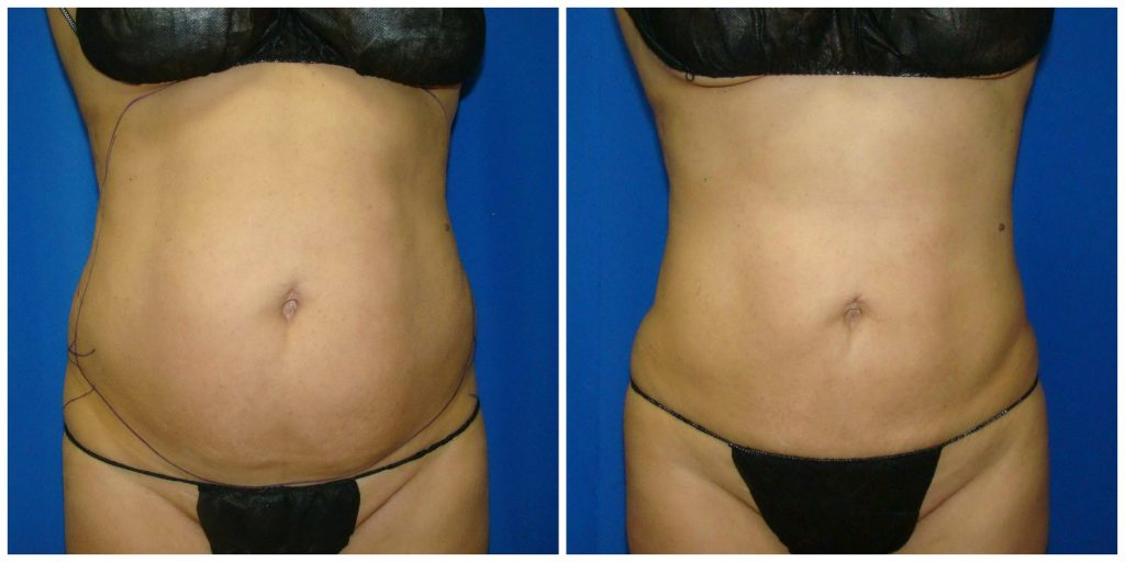 Tummy Tuck (Abdominoplasty) in Houston, TX