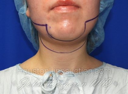 Liposuction Before & After Patient #2653