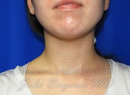 Liposuction Before & After Patient #2653