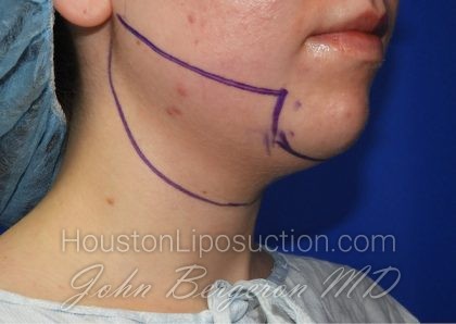 Liposuction Before & After Patient #2653