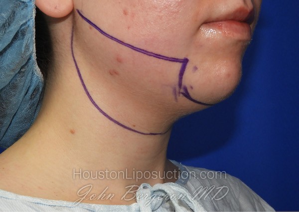 Liposuction Before & After Patient #2653