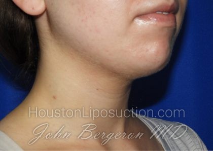 Liposuction Before & After Patient #2653