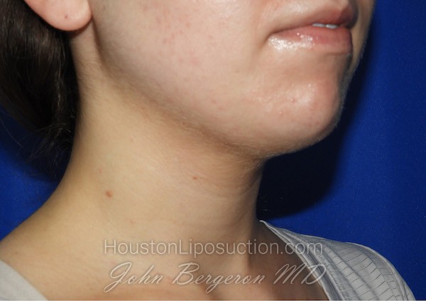 Liposuction Before & After Patient #2653