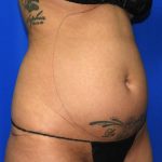 Liposuction Before & After Patient #2673