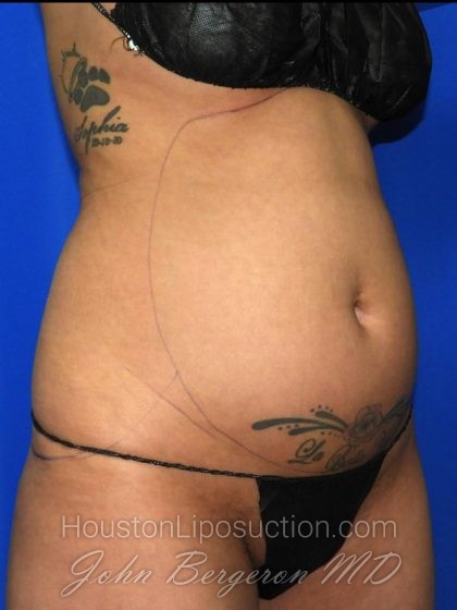 Liposuction Before & After Patient #2673