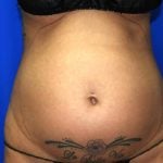 Liposuction Before & After Patient #2673