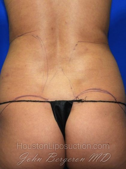 Liposuction Before & After Patient #2673