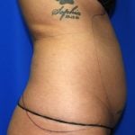 Liposuction Before & After Patient #2673