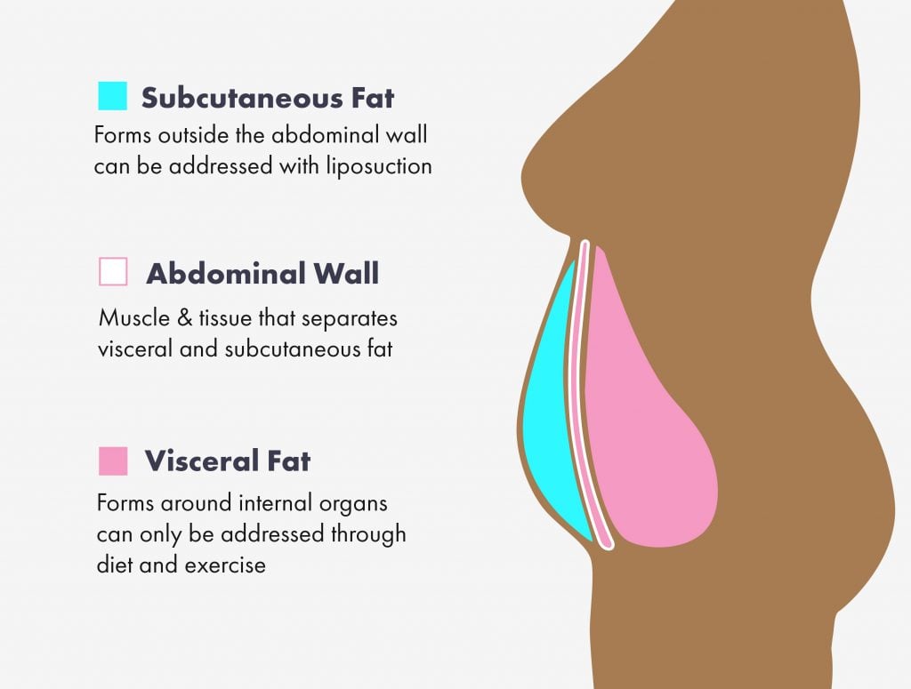 Subcutaneous fat removal