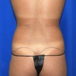 Liposuction Before & After Patient #2720