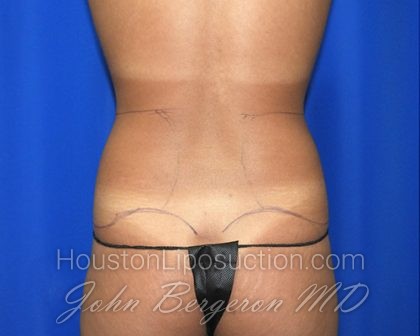 Liposuction Before & After Patient #2720