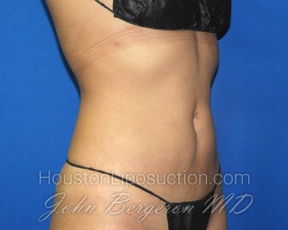 Liposuction Before & After Patient #2720