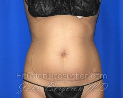 Liposuction Before & After Patient #2720