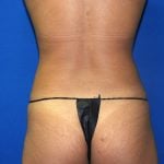 Liposuction Before & After Patient #2720