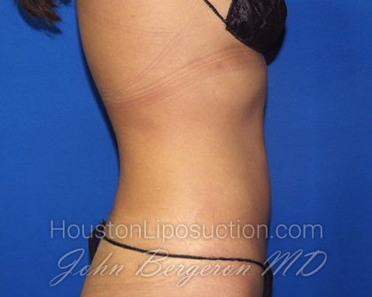 Liposuction Before & After Patient #2720