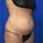 Liposuction Before & After Patient #2750