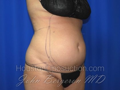 Liposuction Before & After Patient #2750