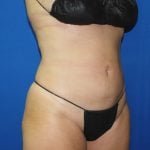 Liposuction Before & After Patient #2750