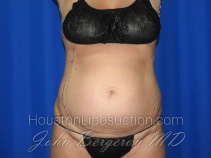 Liposuction Before & After Patient #2750