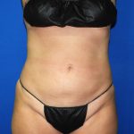 Liposuction Before & After Patient #2750