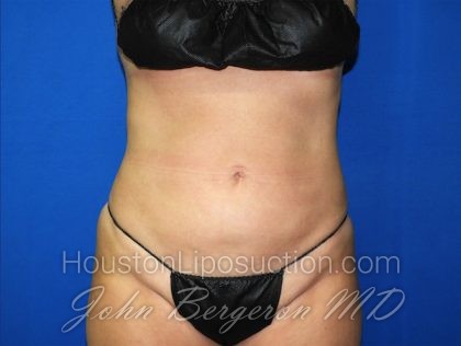 Liposuction Before & After Patient #2750