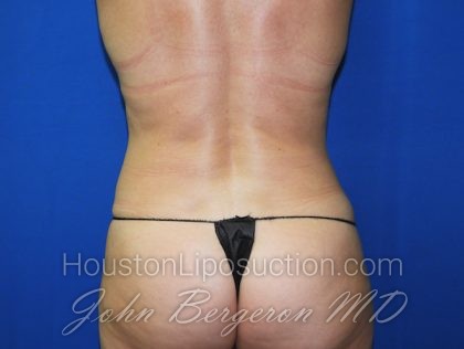 Liposuction Before & After Patient #2750