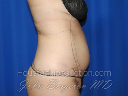 Liposuction Before & After Patient #2750