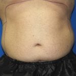 Liposuction Before & After Patient #2741