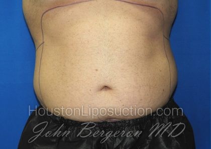 Liposuction Before & After Patient #2741