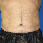 Liposuction Before & After Patient #2741