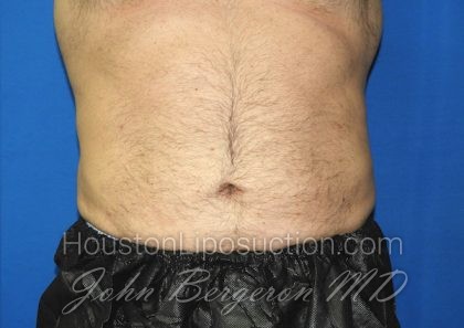 Liposuction Before & After Patient #2741