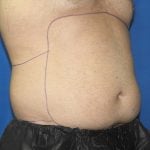 Liposuction Before & After Patient #2741