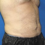 Liposuction Before & After Patient #2741