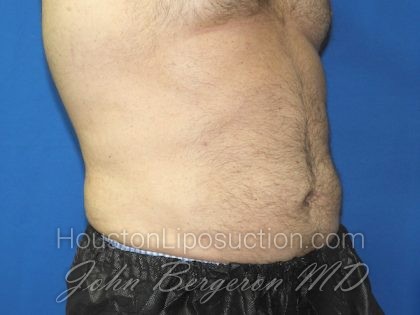 Liposuction Before & After Patient #2741