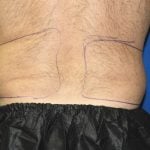 Liposuction Before & After Patient #2741