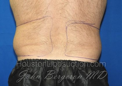 Liposuction Before & After Patient #2741